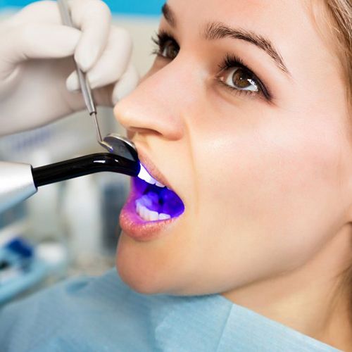 woman getting tooth-colored filling hardened with curing light 