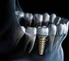 Digital illustration of a dental implant