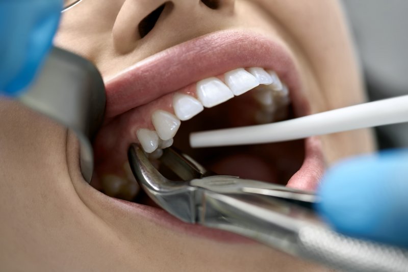 A woman receiving a tooth extraction